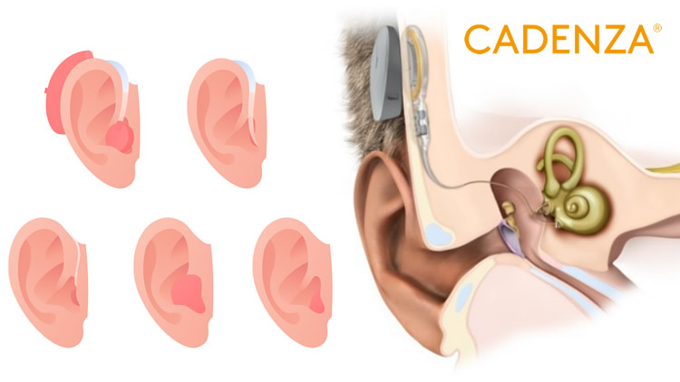 Hearing aids vs cochlear implants